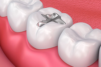 Brian C. Vinson, DMD Family Dentistry | Pediatric Dentistry, Crowns and Sedation Dentistry