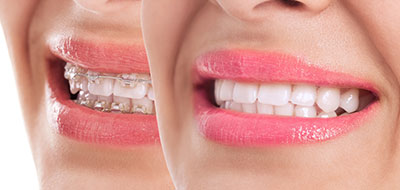 Brian C. Vinson, DMD Family Dentistry | Teeth Whitening, Implant Restorations and CEREC