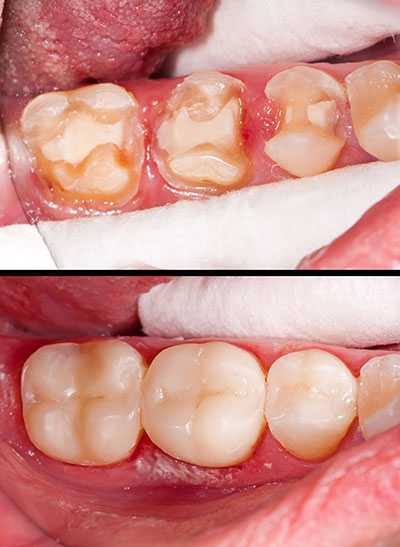 Brian C. Vinson, DMD Family Dentistry | Sedation Dentistry, Full Mouth Reconstruction and Laser Dentistry