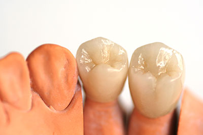 Brian C. Vinson, DMD Family Dentistry | Root Canals, Teeth Whitening and Digital Impressions
