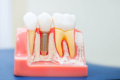 Brian C. Vinson, DMD Family Dentistry | CBCT, Dental Fillings and Invisalign reg 