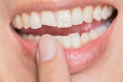Brian C. Vinson, DMD Family Dentistry | Veneers, Dental Fillings and Invisalign reg 