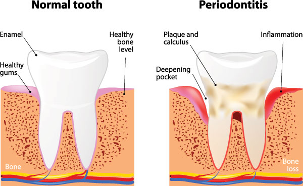 Brian C. Vinson, DMD Family Dentistry | Fluoride Treatment, Night Guards and Dental Sealants